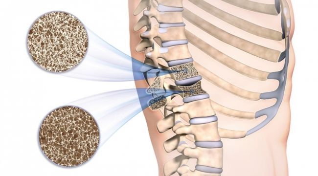 Kemik erimesi 30'lu yaşlarda başlıyor